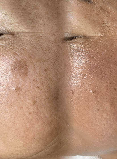 melasma no rosto